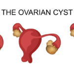 ovarian